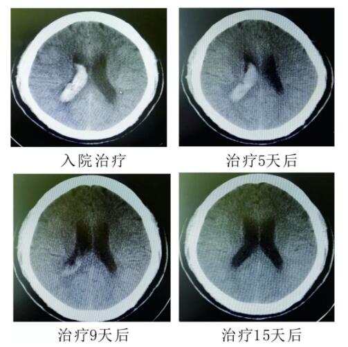 腦出血你不得不引起重視的疾?。。?！
