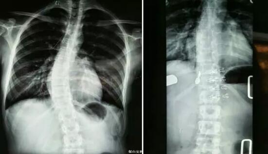 好好的脊柱怎么說彎就彎了？你竟然都沒發(fā)現(xiàn)……