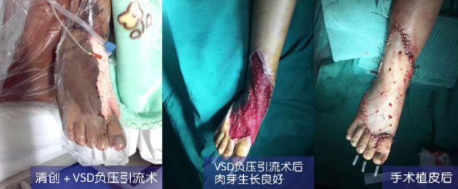 車禍猛如虎，救治如“華佗” ，手術(shù)＋康復(fù)，8歲小女孩車禍后日漸康復(fù)行走