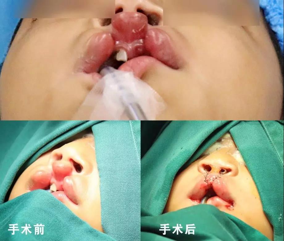 唇腭裂盡早治療消除孩子自卑心理，快樂成長！