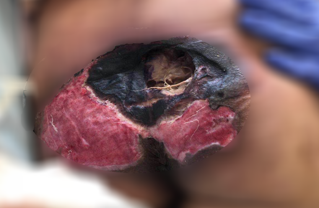 癱瘓3年的女患者臀部居然變成這樣?！