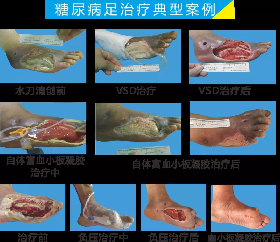 截肢、失明，甚至……，我們要做的是將糖尿病并發(fā)癥遏制在搖籃里！