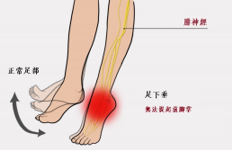 【保山安利醫(yī)院—健康科普】什么是足下垂！你了解嗎？