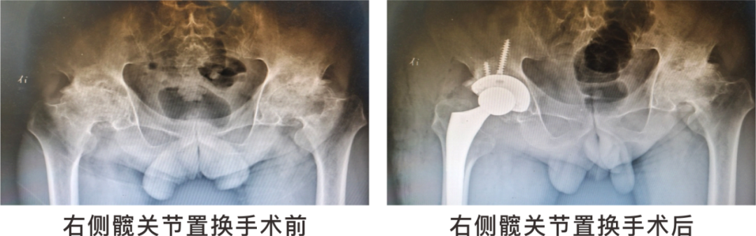 【保山安利醫(yī)院】長期飲酒導(dǎo)致雙側(cè)股骨頭壞死，髖關(guān)節(jié)置換后重獲運動功能！