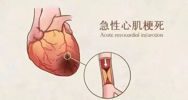 【保山安利醫(yī)院】11月20日“心梗救治日” 時(shí)間就是心肌，時(shí)間就是生命！